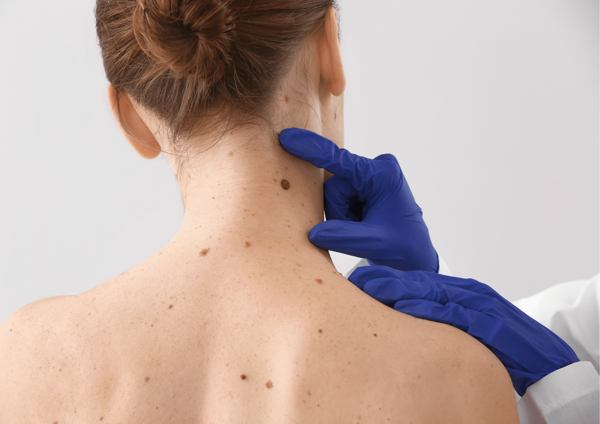 Skin Tag & Wart Removal Skin Tag & Wart Removal